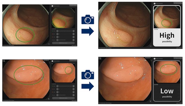 图3 : 在检查过程中，通过内视镜设备拍摄的影片自动检测疑似病变。然后医生撷取静止影像（左），并很快显示分析结果（右）。（source：日本NEC）