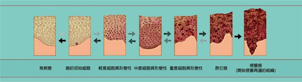 图2 : 形成恶性肿瘤前的细胞变异过程（source：NCI Division of Cancer Prvention）